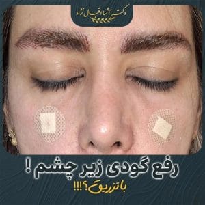 عکس فیلر زیر چشم و نمونه کار دکتر آتسا اقبال نژاد https://dreghbalnejad.ir/
