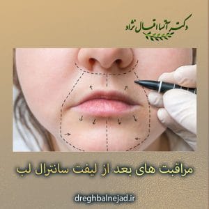 مراقیت های بعد از لیفت سانترال لب https://dreghbalnejad.ir/