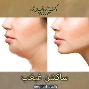ساکشن غبغب https://dreghbalnejad.ir/