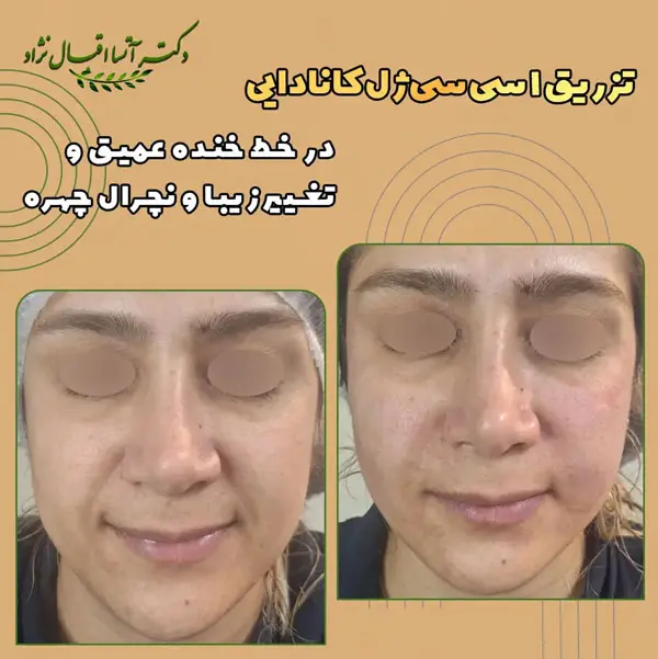 نمونه عکس قبل و بعد تزریق ژل در اصفهان - دکتر اقبال نژاد