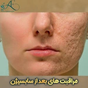 مراقبت های بعد از سابسیژن