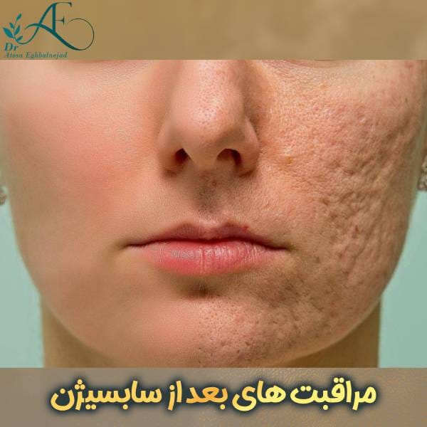 مراقبت های بعد از سابسیژن