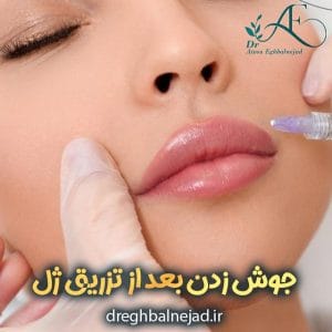 جوش زدن بعد از تزریق ژل https://dreghbalnejad.ir/