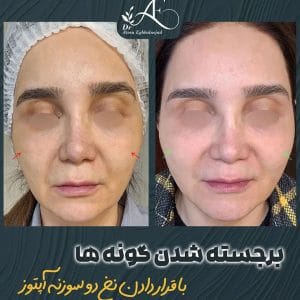 عکسهای لیفت صورت با نخ