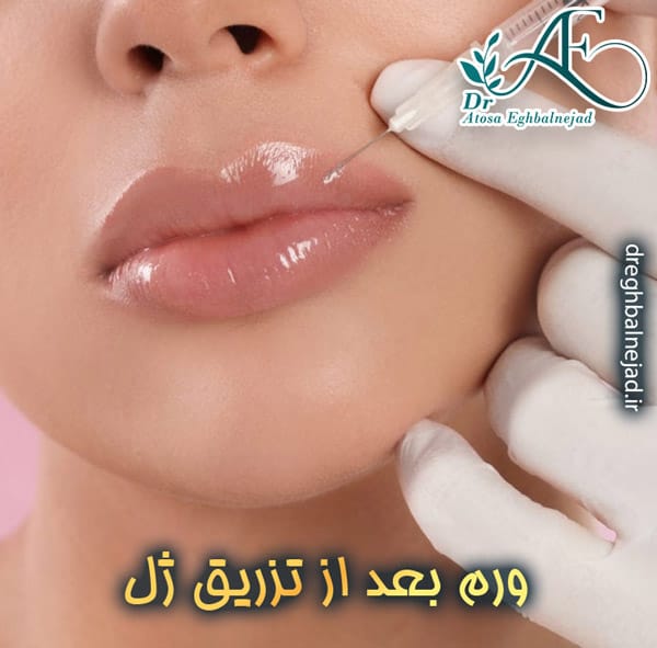 ورم بعد از تزریق ژل