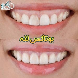 بوتاکس لثه