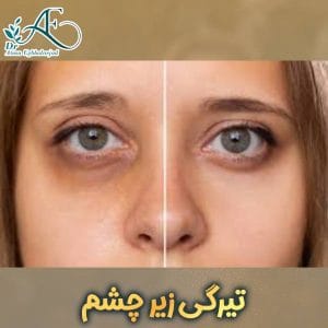 تیرگی زیر چشم