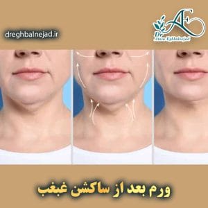 ورم بعد از ساکشن غبغب