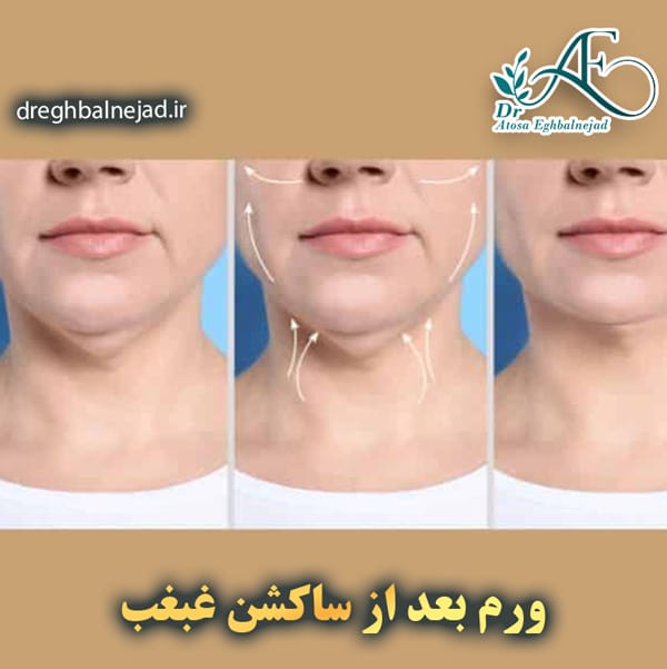 ورم بعد از ساکشن غبغب