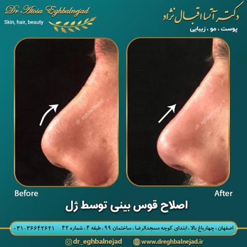 اصلاح-قوز-بینی-با-ژل