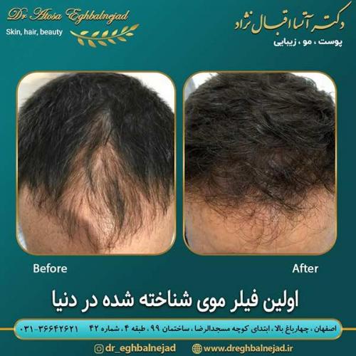 اولین-فیلر-موی-شناخته-شده-در-دنیا