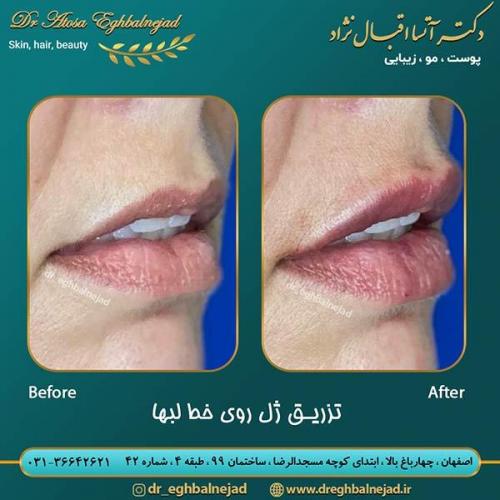تزری-ژل-روی-خط-لب-ها