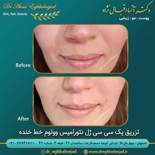 تزریق-1-سی-سی-ژل-خط-خنده-نئورامیس-وولوم-خط-خنده