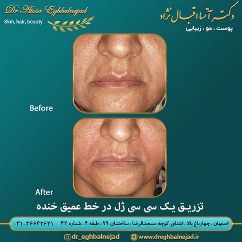 تزریق-1-سی-سی-ژل-در-خط-عمیق-خنده