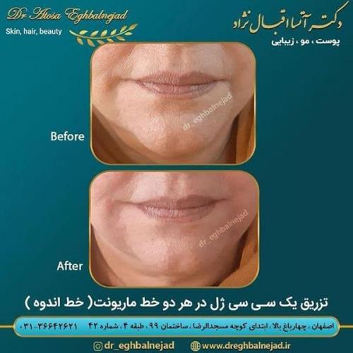 تزریق-1-سی-سی-ژل-در-هر-دو-خط-ماریونت-یا-خط-اندوه