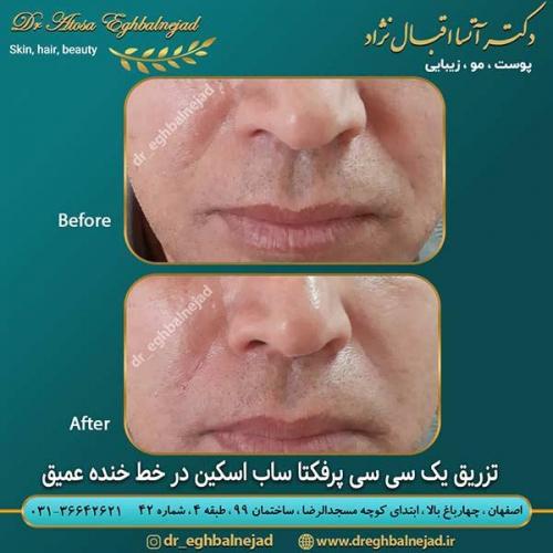 تزریق-1-سی-سی-ژل-پرفکتا-ساب-اسکین-در-خط-خنده-عمیق