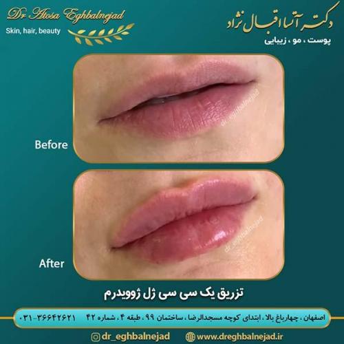 تزریق-1-سی-سی-ژل-ژوویدرم