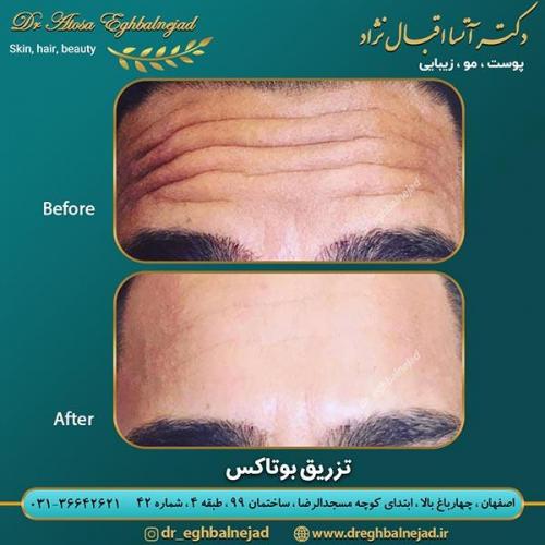 تزریق-بوتاکس-2