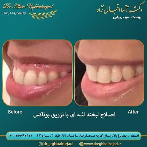 تزریق-بوتاکس-3