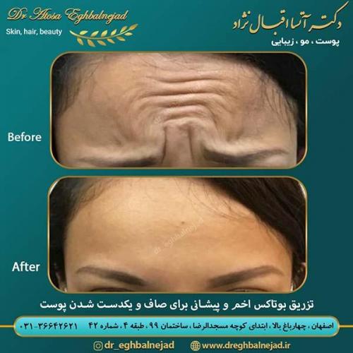 تزریق-بوتاکس-اخم-و-پیشانی-برای-صاف-و-یکدست-شدن-پوست