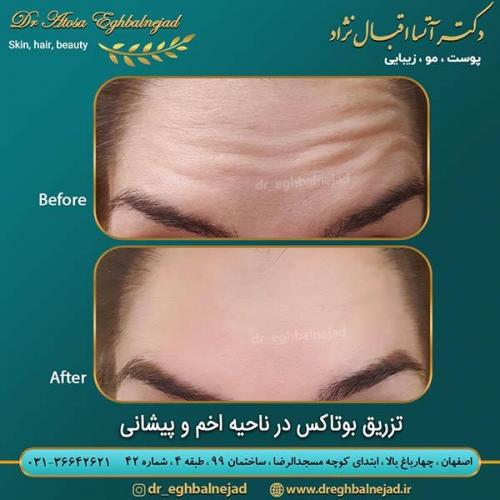 تزریق-بوتاکس-در-ناحیه-اخم-و-پیشانی