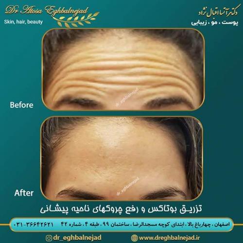 تزریق-بوتاکس-و-رفع-چروکهای-ناحیه-پیشانی