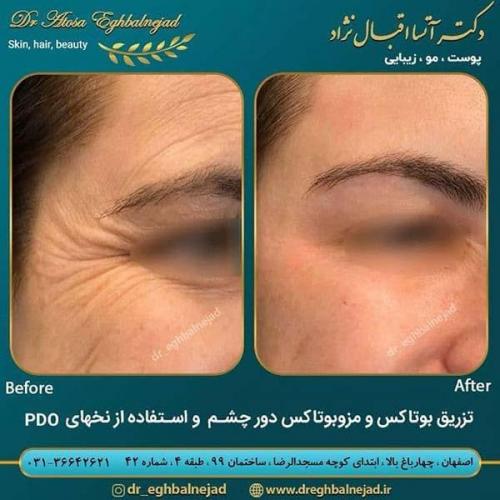 تزریق-بوتاکس-و-مزوبوتاکس-دور-چشم