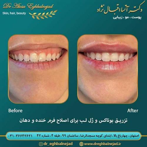 تزریق-بوتاکس-و-ژل-برای-اصلاح-فرم-خنده