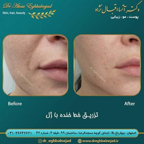 تزریق-خط-خنده-با-ژل