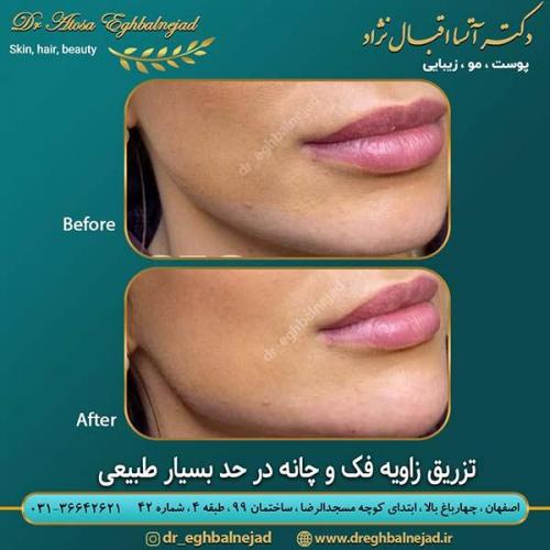 تزریق-زاویه-فک-و-چانه-در-حد-بسیار-طبیعی