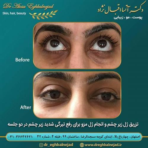 تزریق-زل-زیر-چشم-و-ژل-مزو-برای-رفع-تیرگی-شدید-زیر-چشم