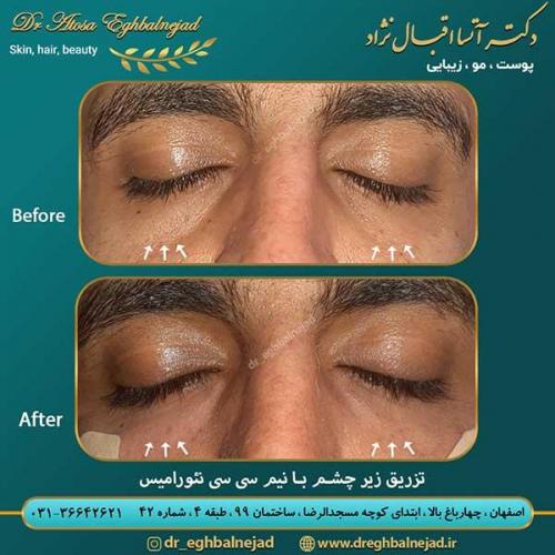 تزریق-زیر-چشم-با-نیم-سی-سی-نئورامیس