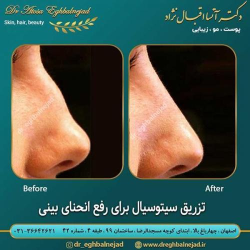 تزریق-سیستوسیال-برای-رفع-انحنای-بینی