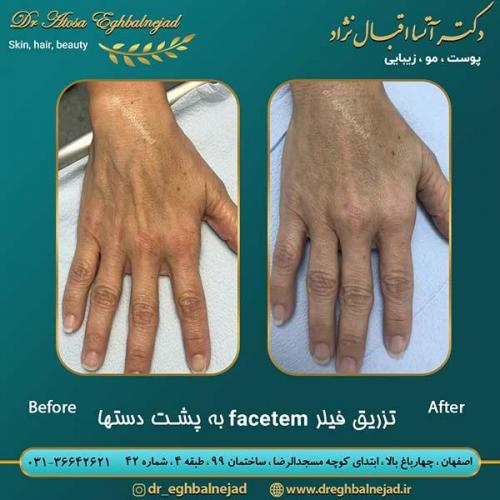تزریق-فیلر-1-facetem-به-پشت-دست-ها