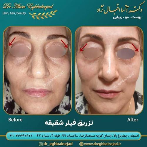 تزریق-فیلر-1