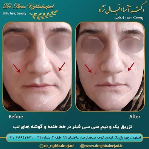 تزریق-فیلر-2