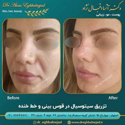 تزریق-فیلر-3