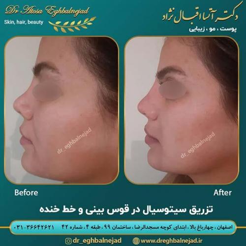 تزریق-فیلر-4
