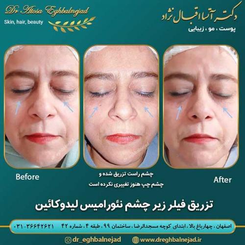 تزریق-فیلر-5