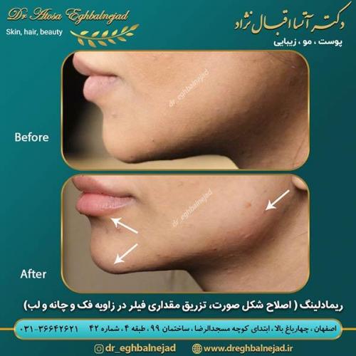 تزریق-فیلر-5 (1)