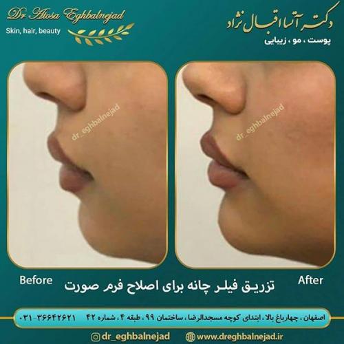 تزریق-فیلر-6