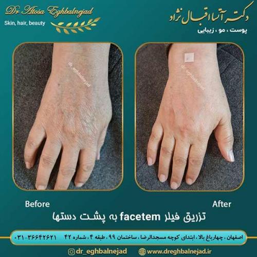 تزریق-فیلر-facetem-به-پشت-دست-ها