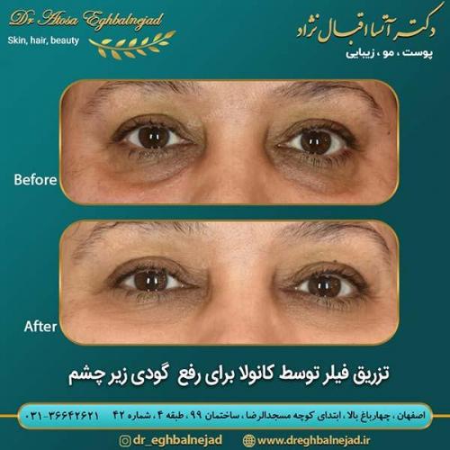 تزریق-فیلر-با-کانولا-برای-رفع-گودی-زیر-چشم
