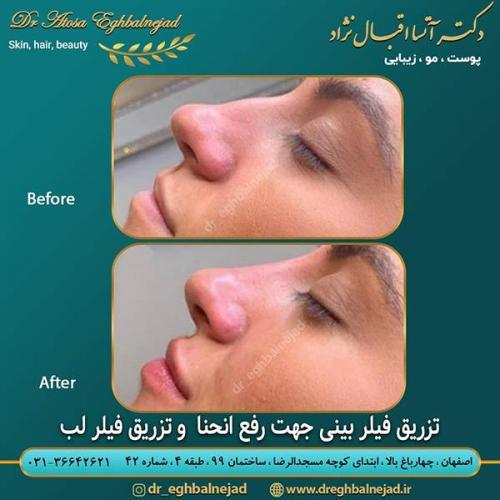 تزریق-فیلر-بینی-جهت-رفع-انحنا