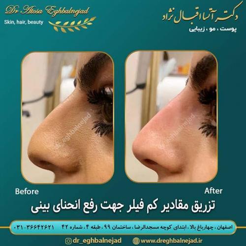 تزریق-فیلر-جهت-رفع-انحنای-بینی