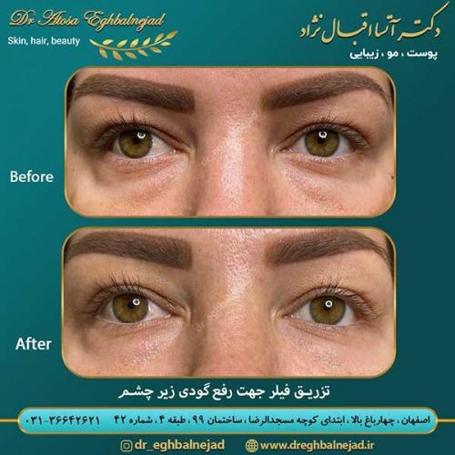 تزریق-فیلر-جهت-رفع-گودی-زیر-چشم