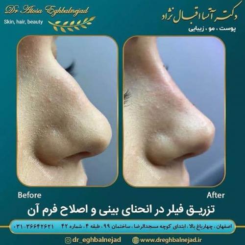 تزریق-فیلر-در-انحنای-بینی-و-اصلاح-فرم-آن