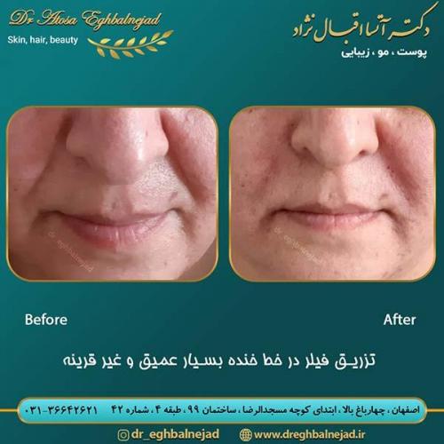 تزریق-فیلر-در-خط-خنده-بسیار-عمیق-و-غیر-قرینه