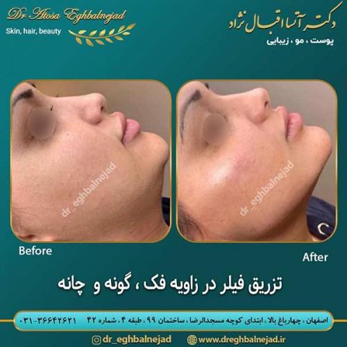 تزریق-فیلر-در-زاویه-فک-گونه-و-چانه