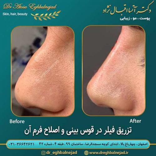 تزریق-فیلر-در-قوس-بینی-و-اصلاح-فرم-آن